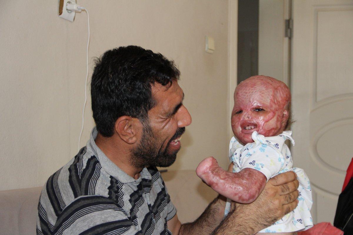 Suriyeli Delal bebek, yanıklarına rağmen hayata tutundu