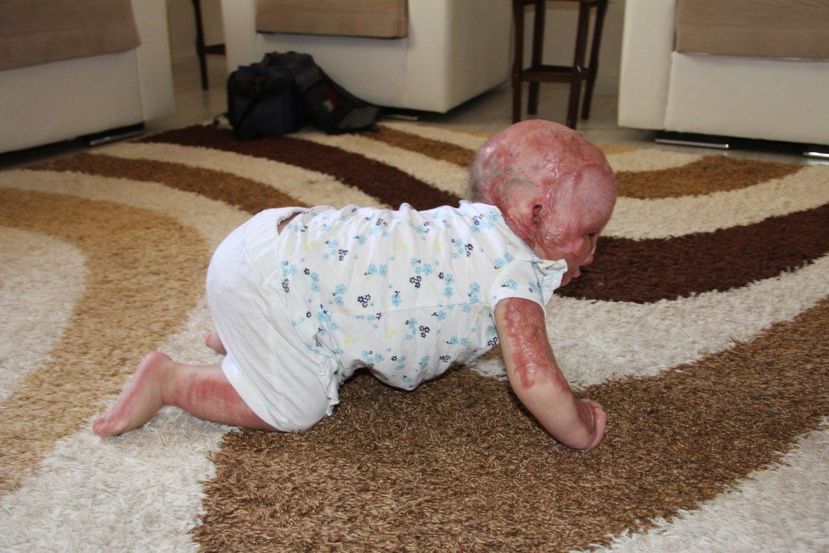 Suriyeli Delal bebek, yanıklarına rağmen hayata tutundu