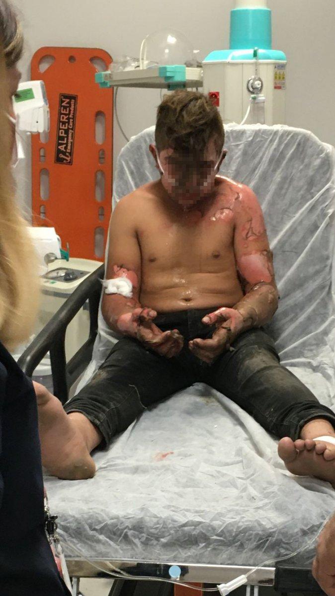 Sakarya'da ateşe tiner döken 2 çocuk yandı