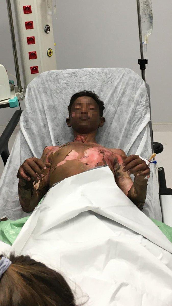 Sakarya'da ateşe tiner döken 2 çocuk yandı