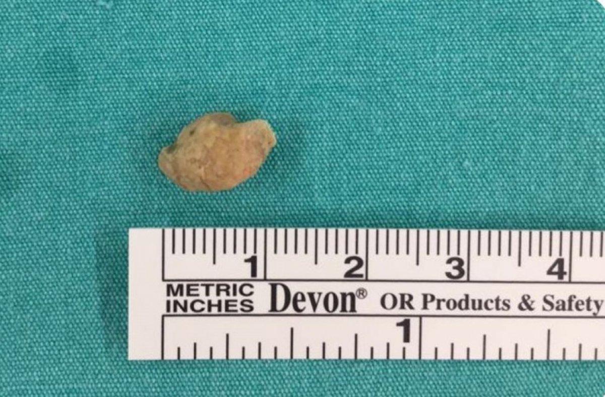 İstanbul'da bir kadının tükürük bezinde taş çıktı