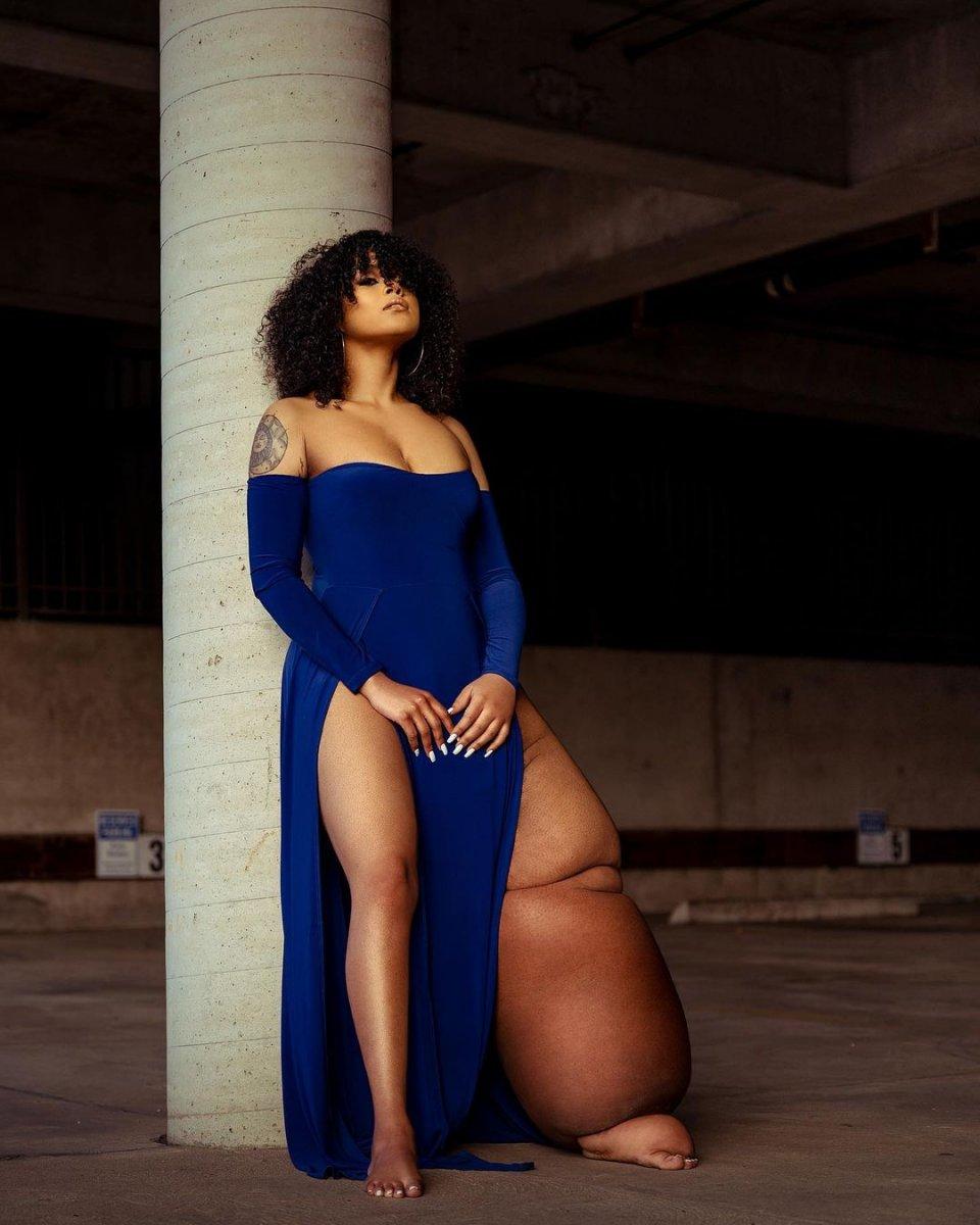 Doğuştan lenfödemli genç kadın görünüşüyle barışık yaşıyor