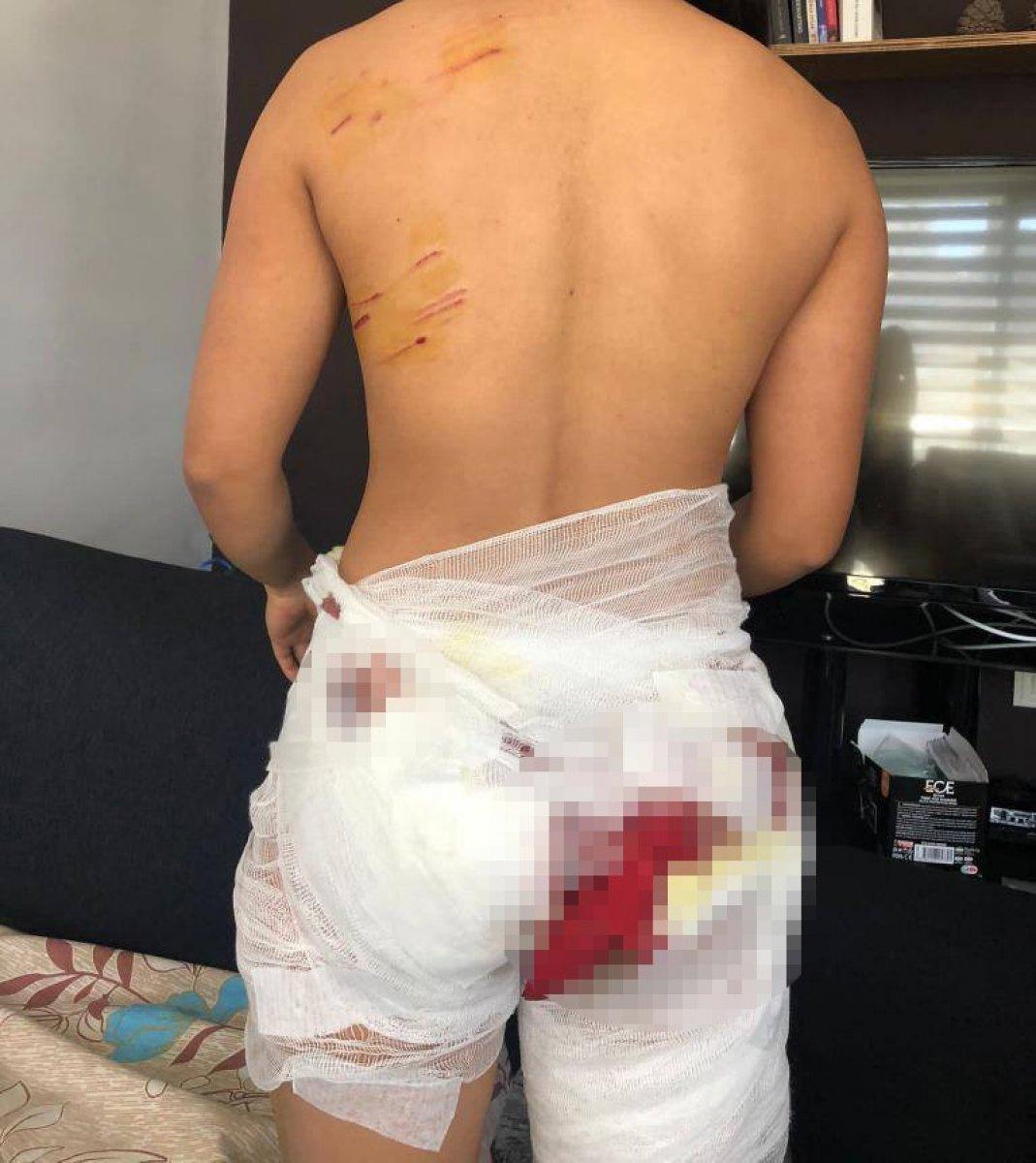 Antalya'da sokak köpeklerinin saldırdığı Endonezyalı kadın ağır yaralandı