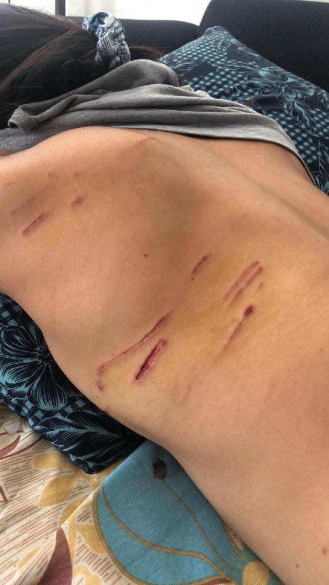 Antalya'da sokak köpeklerinin saldırdığı Endonezyalı kadın ağır yaralandı