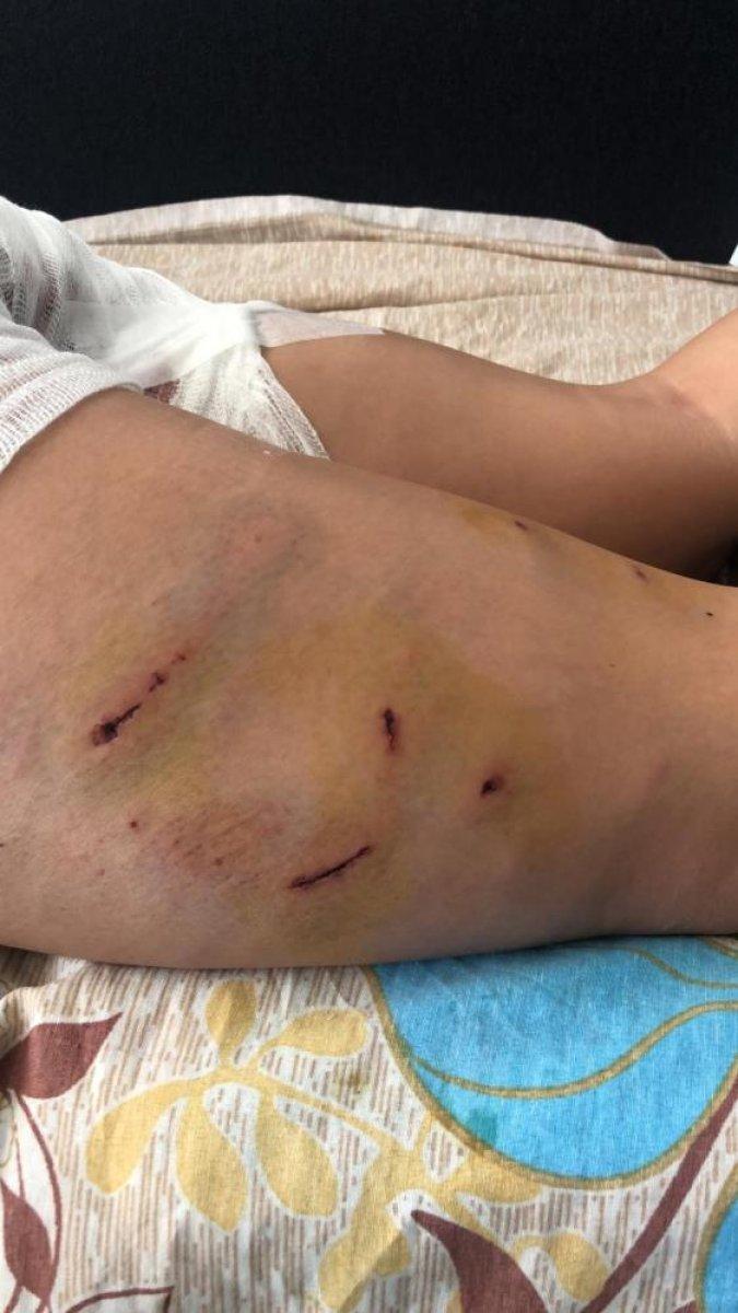 Antalya'da sokak köpeklerinin saldırdığı Endonezyalı kadın ağır yaralandı