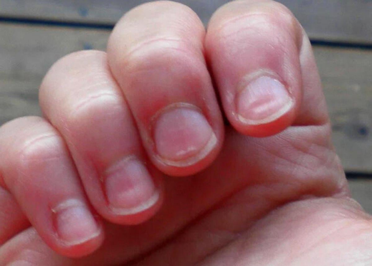 Tırnaklarda oluşan çizgilerin nedenleri