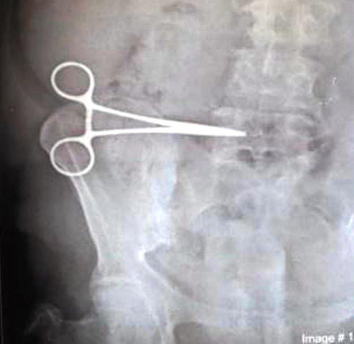 Aydın'da karnında unutulan makasla iki ay yaşadı