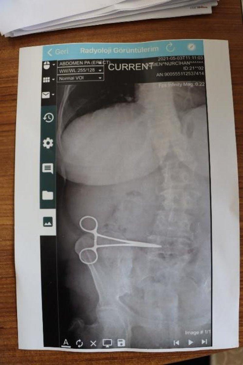 Aydın'da karnında unutulan makasla iki ay yaşadı