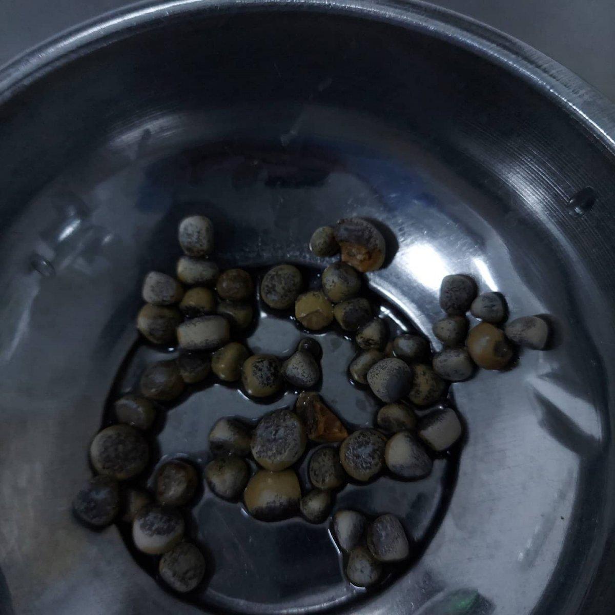 Aksaray’da mesanesinden 50 taş çıkarıldı