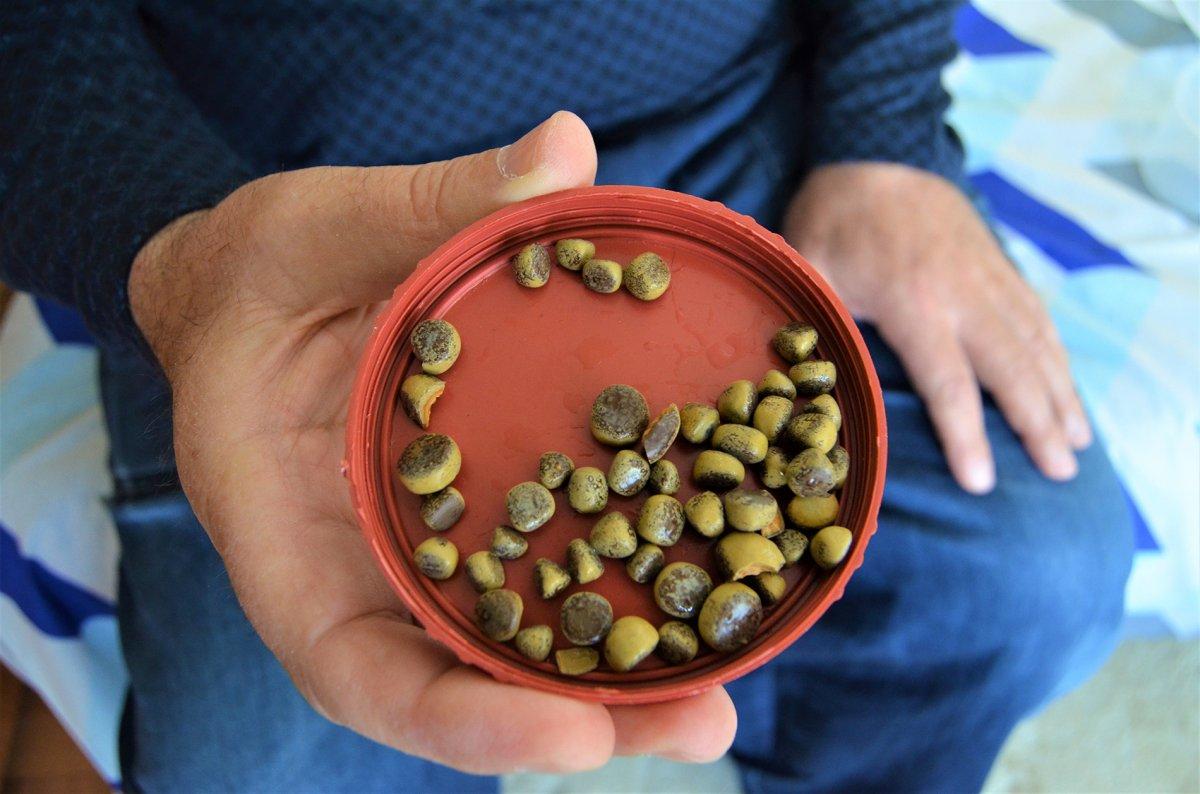 Aksaray’da mesanesinden 50 taş çıkarıldı