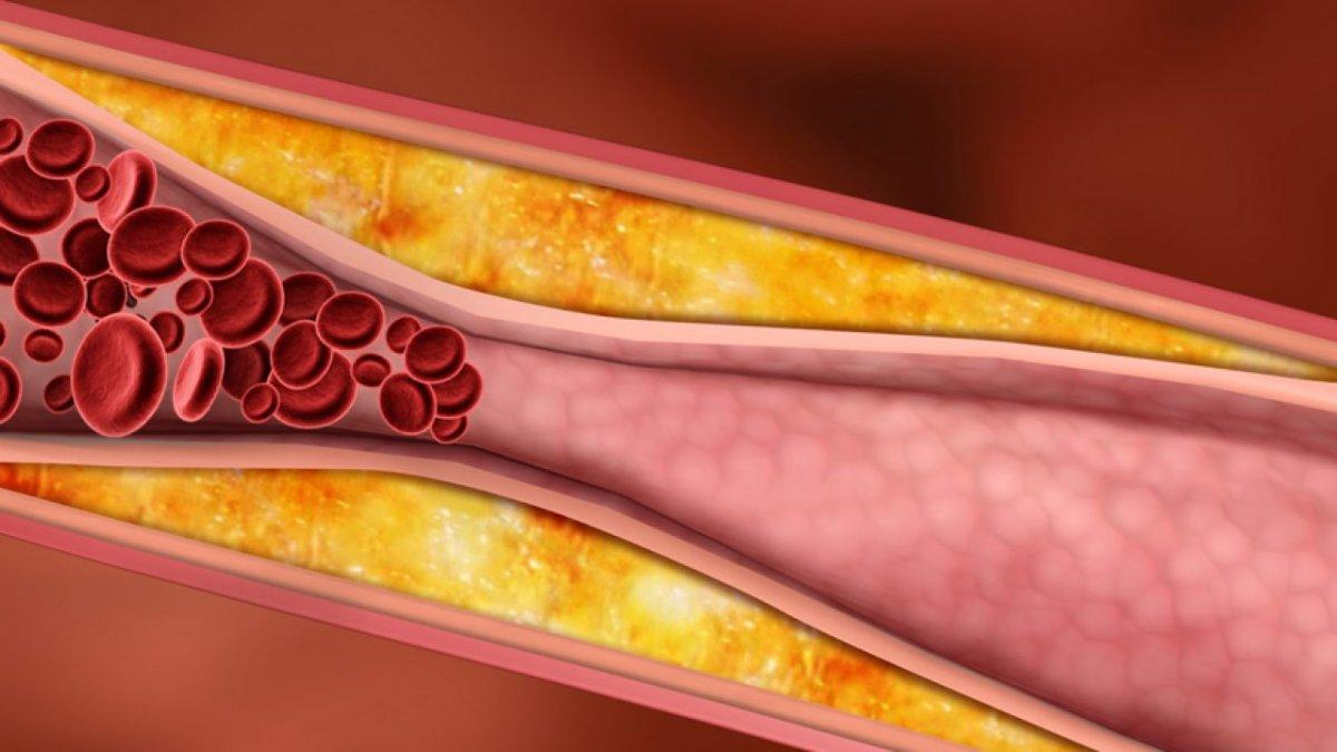 Kan pıhtılarını önleyen 7 besin