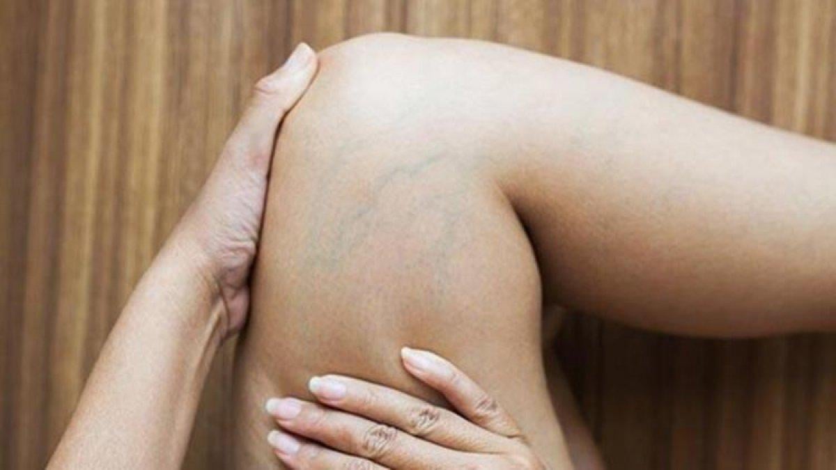 Böbreklerin bozulmaya başladığında verdiği 7 belirti