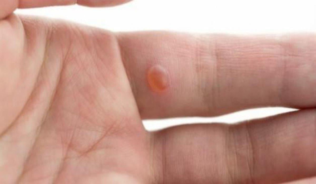 Siğilleri yok etmek için 10 doğal çözüm