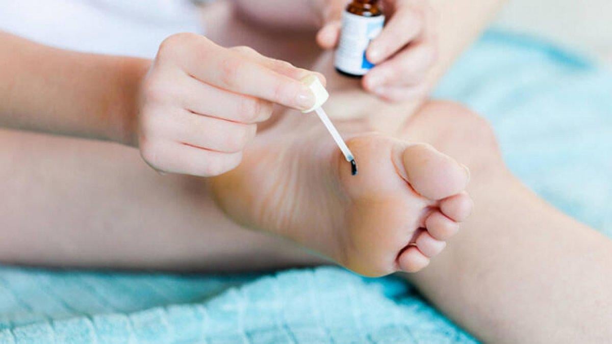 Siğilleri yok etmek için 10 doğal çözüm