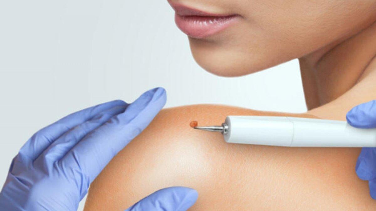 Siğilleri yok etmek için 10 doğal çözüm