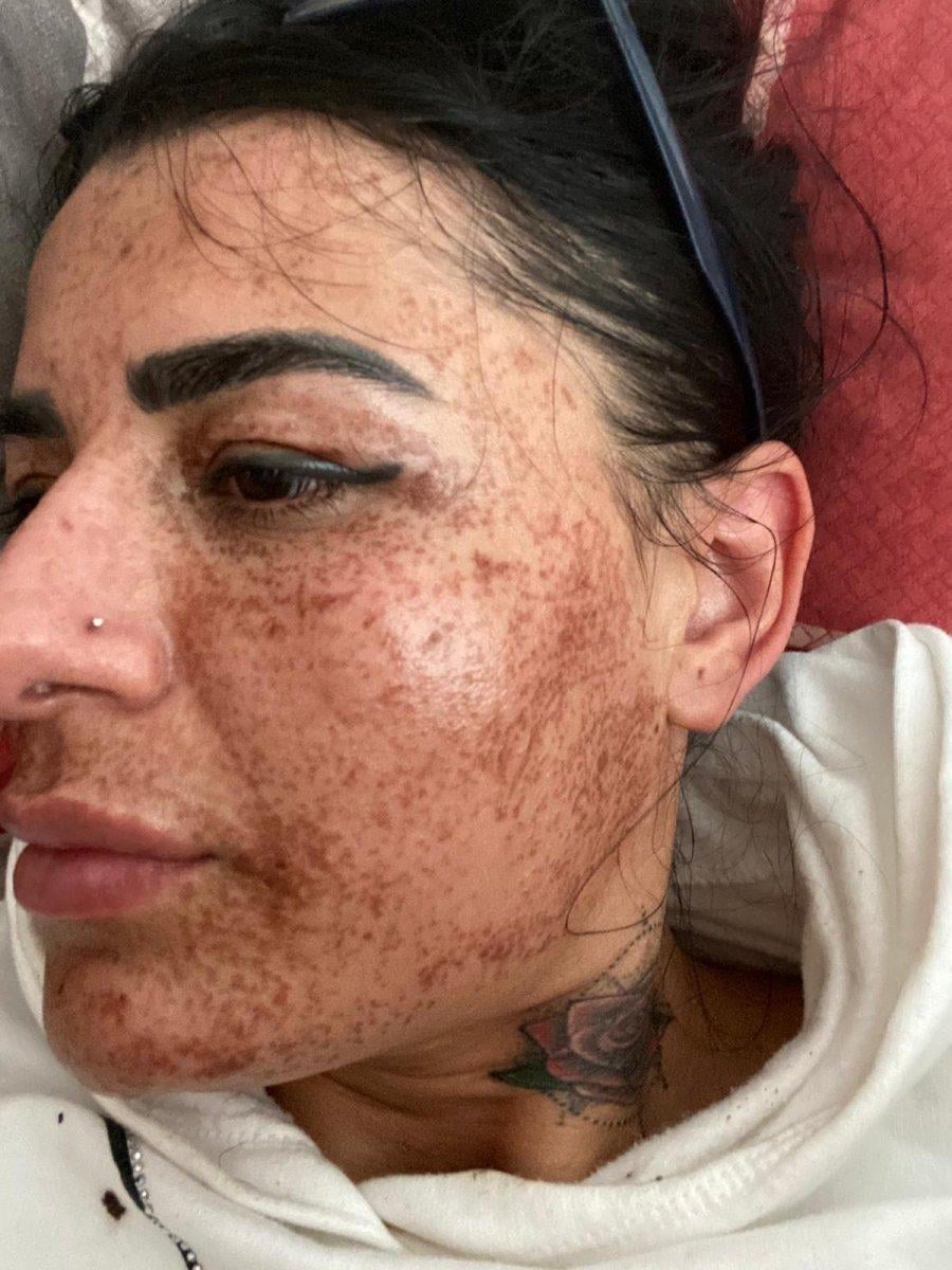 Antalya’da ilanla cilt bakımı yaptırdı, iyileşmesi 8 ay sürdü