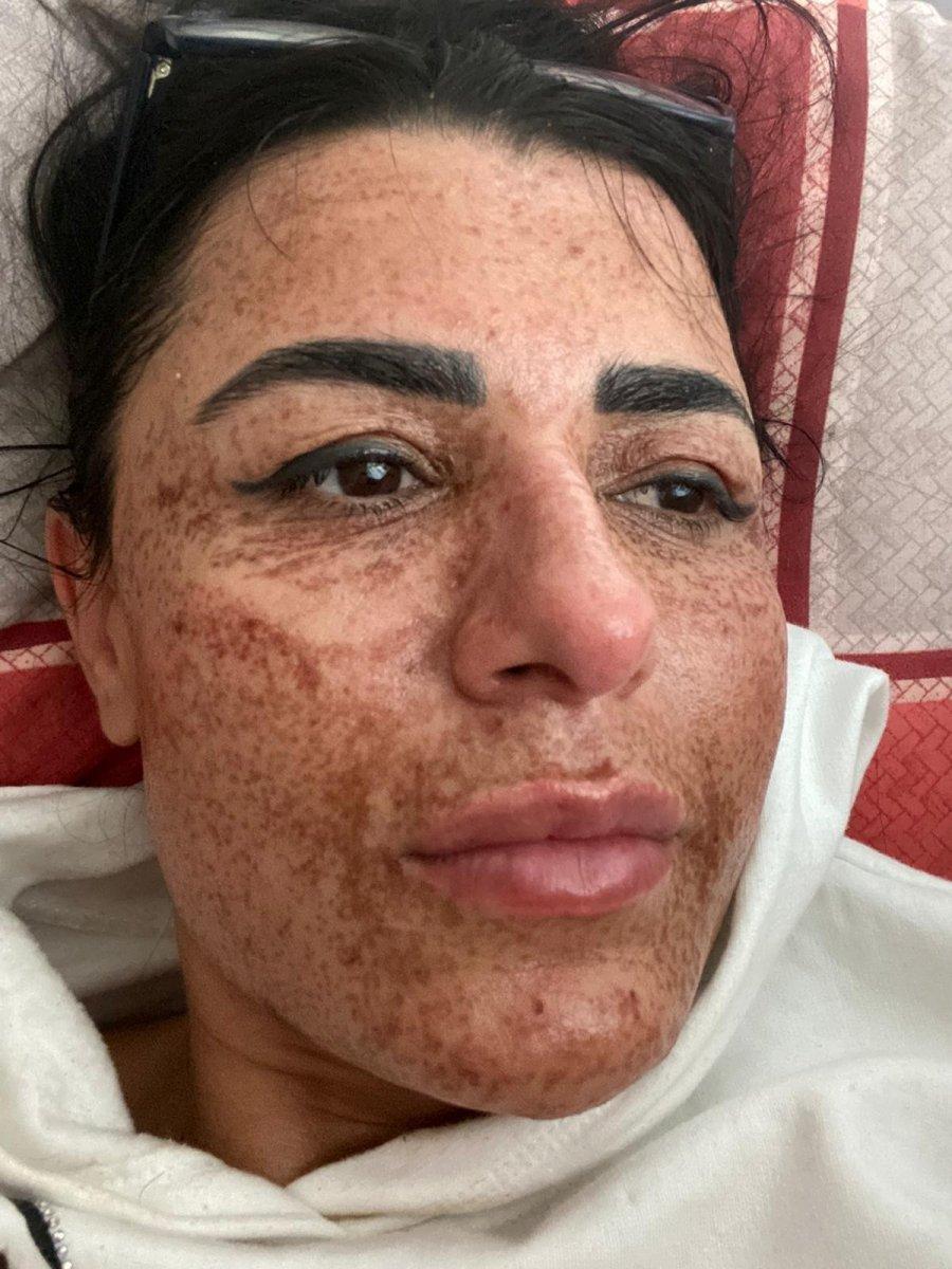 Antalya’da ilanla cilt bakımı yaptırdı, iyileşmesi 8 ay sürdü