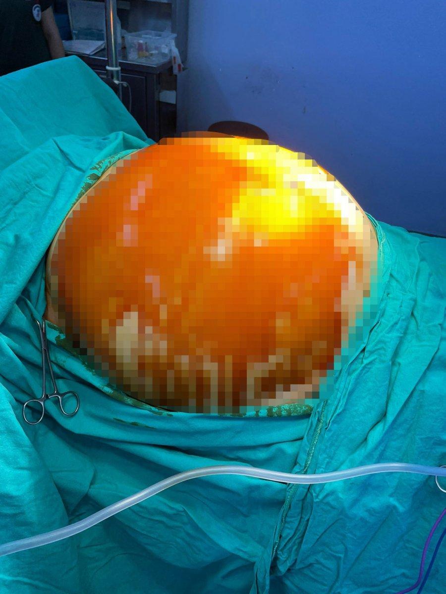 Aydın’da safra kesesi taşı dendi, karnından 15 kilo tümör çıkarıldı