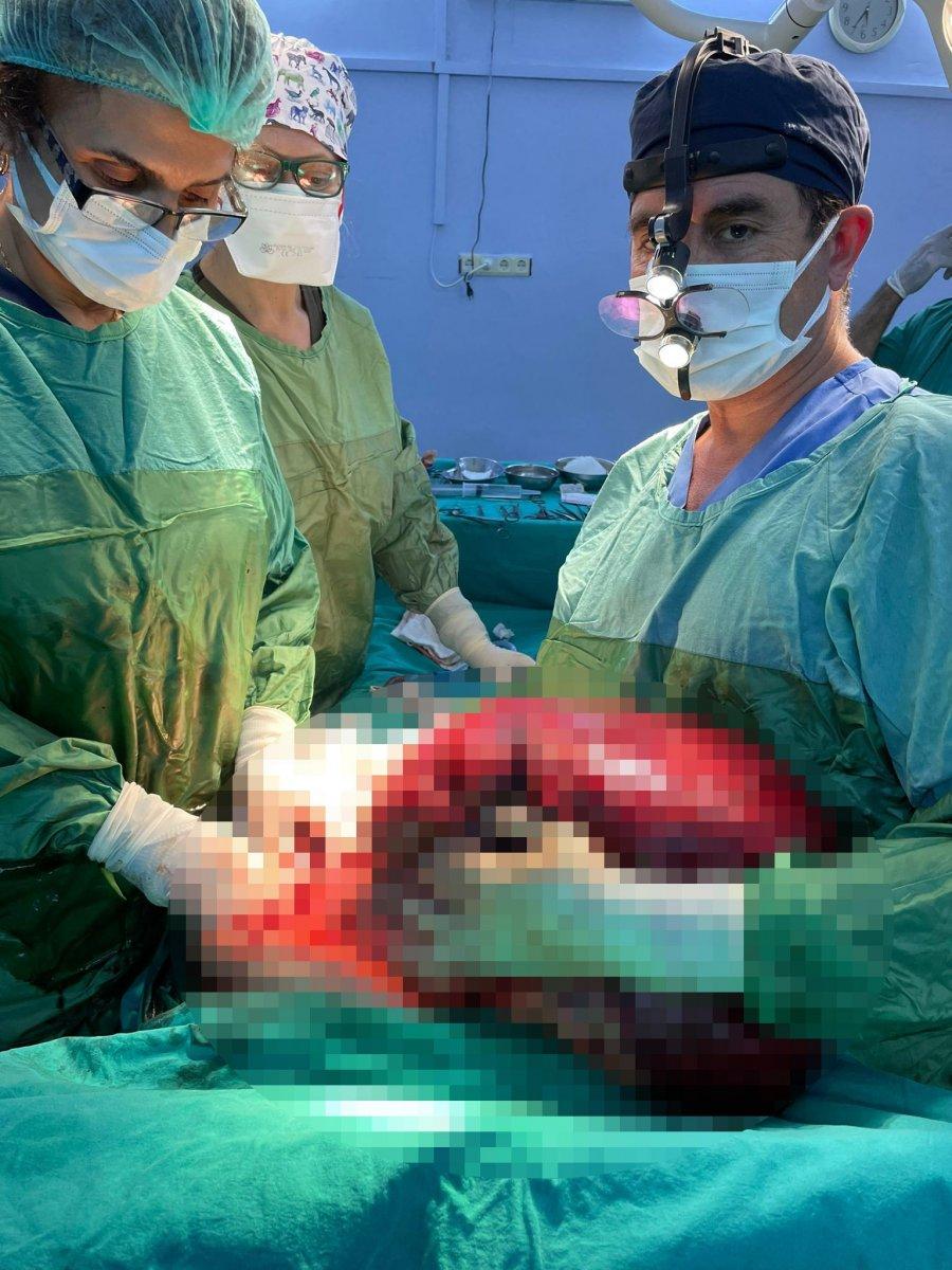 Aydın’da safra kesesi taşı dendi, karnından 15 kilo tümör çıkarıldı