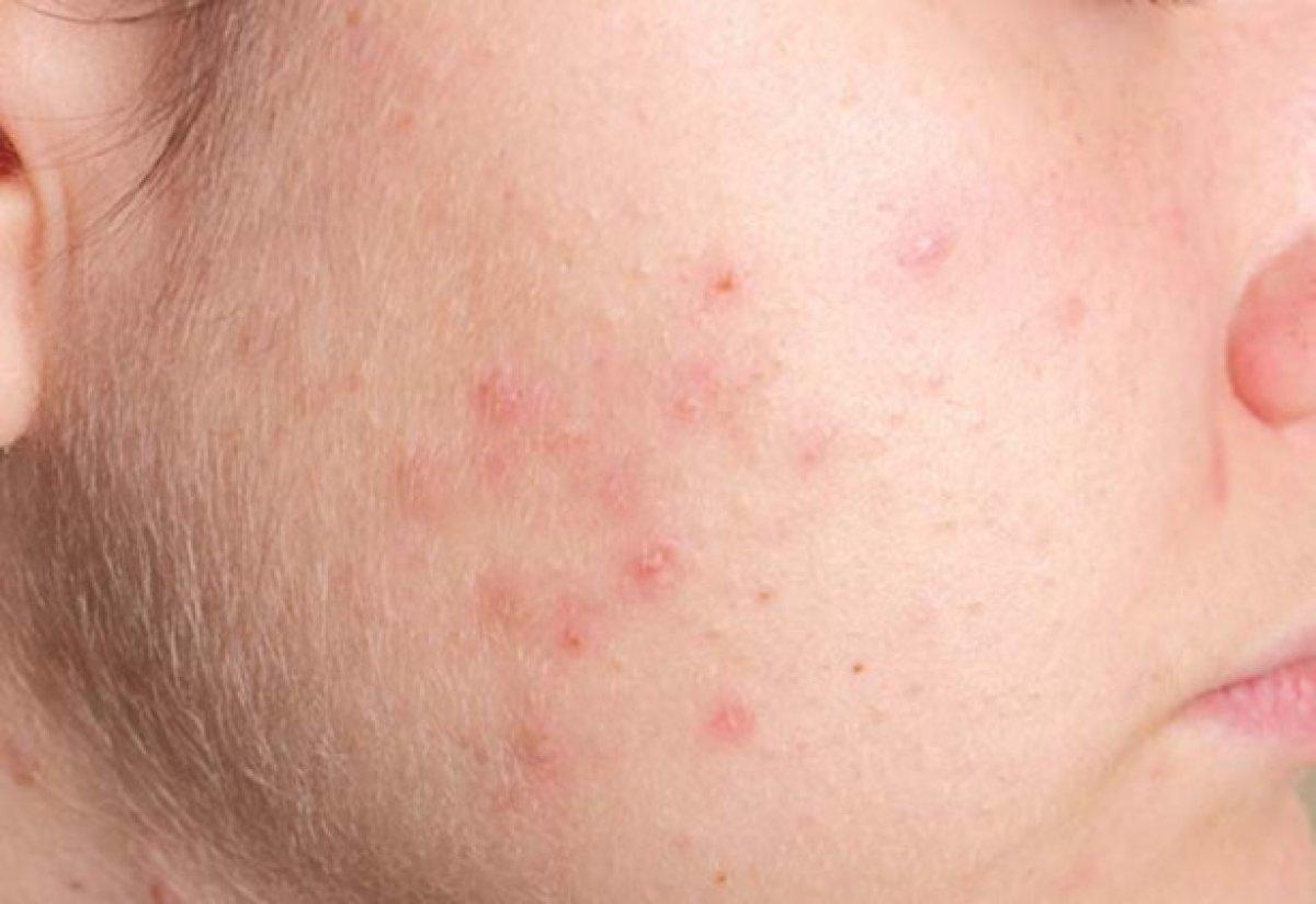 'Maskne'yi önlemek için ipuçları