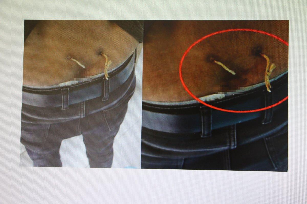 Elazığ'da ağrıları geçsin diye belinden çamaşır ipi geçirdiler