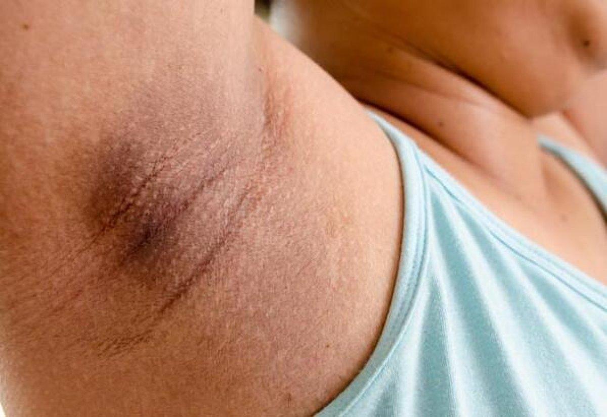 Leke ve kararmalara elveda: Cilt beyazlatıcı karbonat kürü