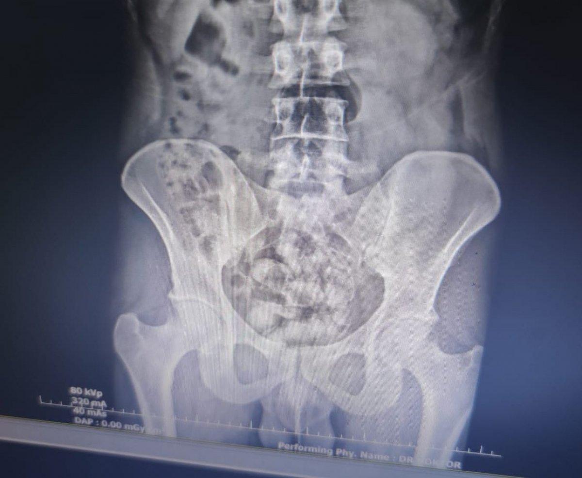 Van'da yakalanan İranlının midesinden 25 kapsül uyuşturucu çıktı