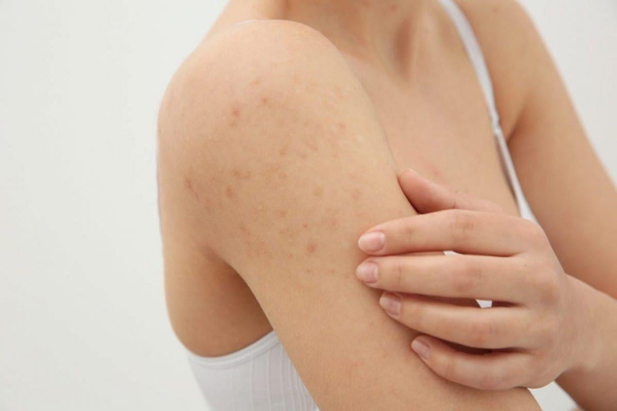 Koldaki küçük sivilcelere karşı doğal çözümler