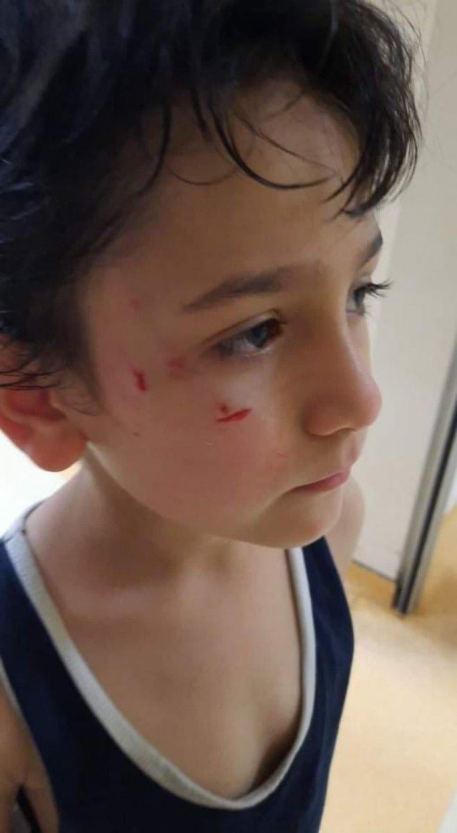 Bursa’da sokak köpeği 8 yaşındaki çocuğa saldırdı