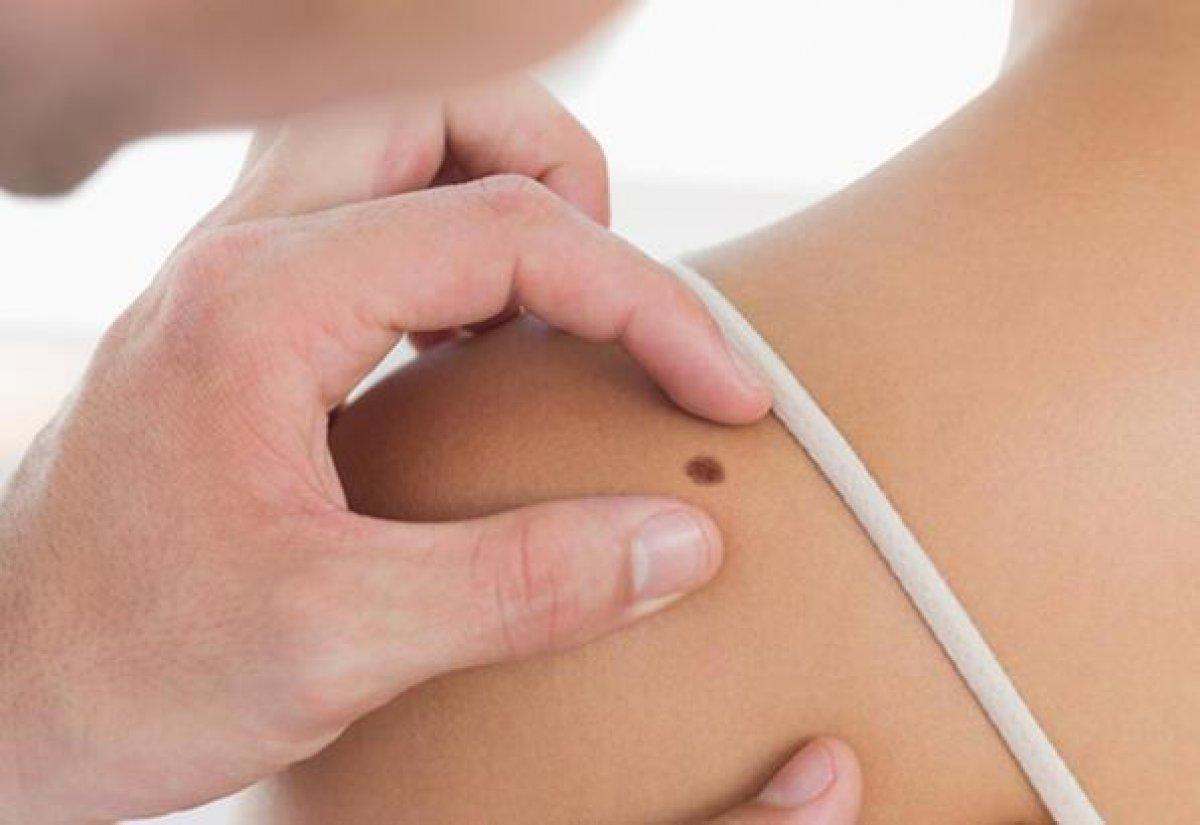 Cilt kanseri riskini artıran 8 faktör