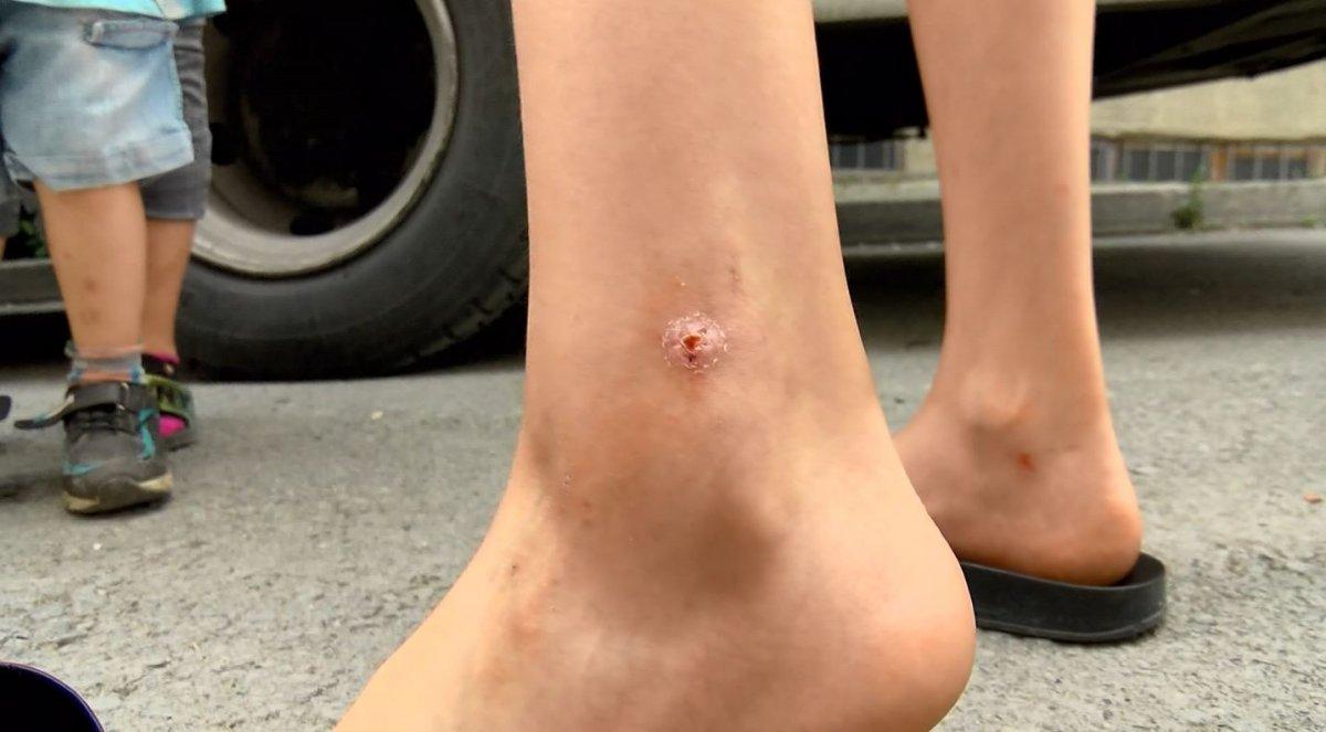 Avcılar’da sivrisinek ısırıkları ile çocuklarda oluşan yaralar paniğe neden oldu