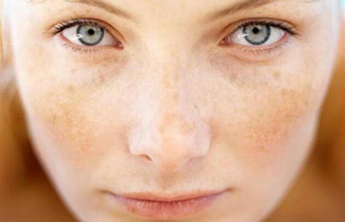 Cilt kanseri riskini artıran 8 faktör