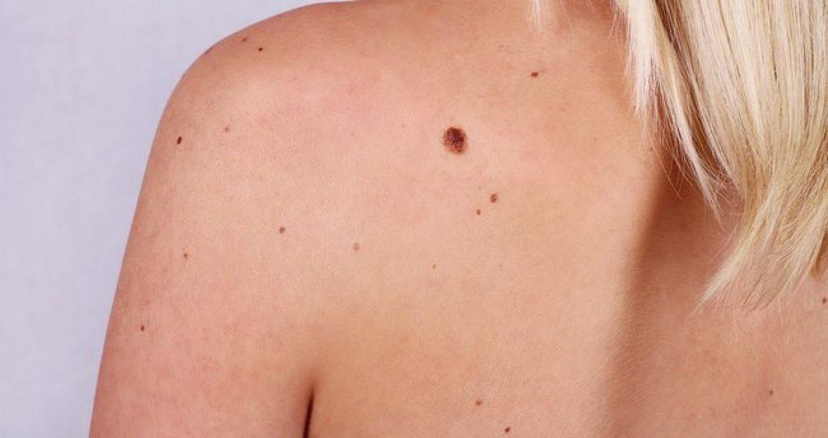 Cilt kanseri riskini artıran 8 faktör