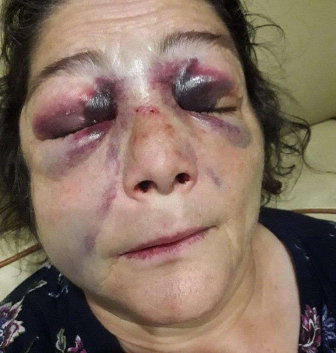 CHP'li belediye başkanının adamları tarafından darbedildiğini söyledi