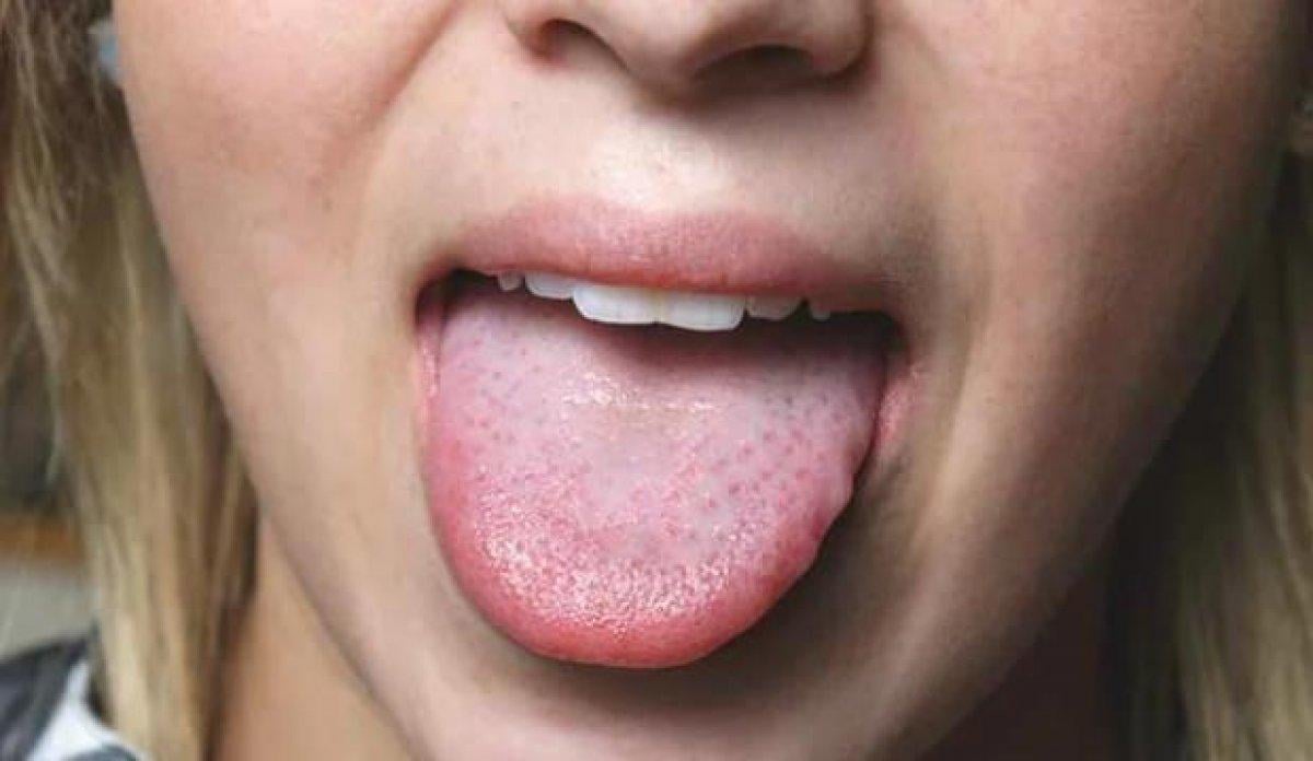 Dil, sağlık durumunu yansıtıyor