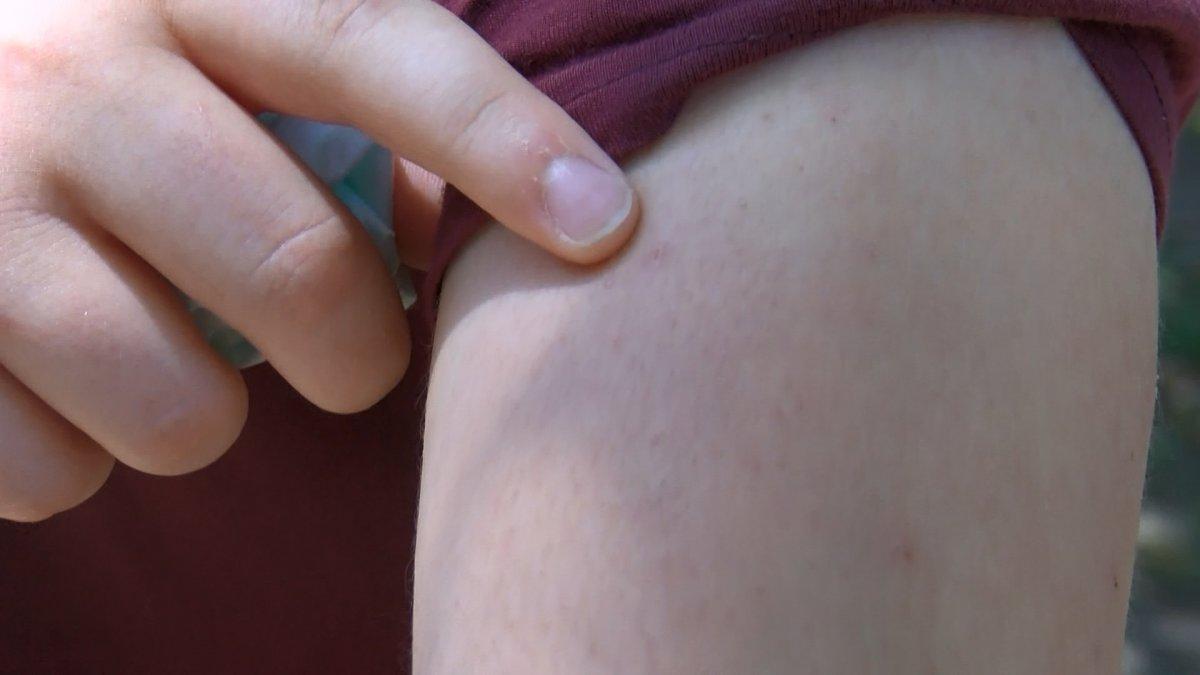 İstanbul'da Asya Kaplan Sivrisineği istilası