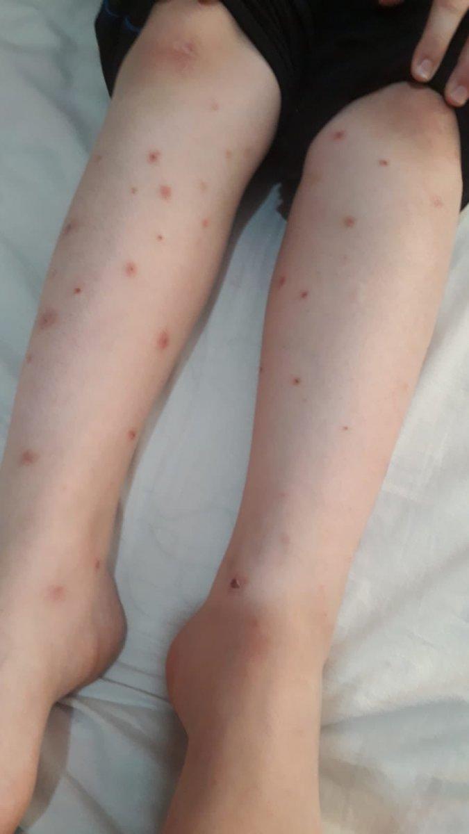 İstanbul'da Asya Kaplan Sivrisineği istilası