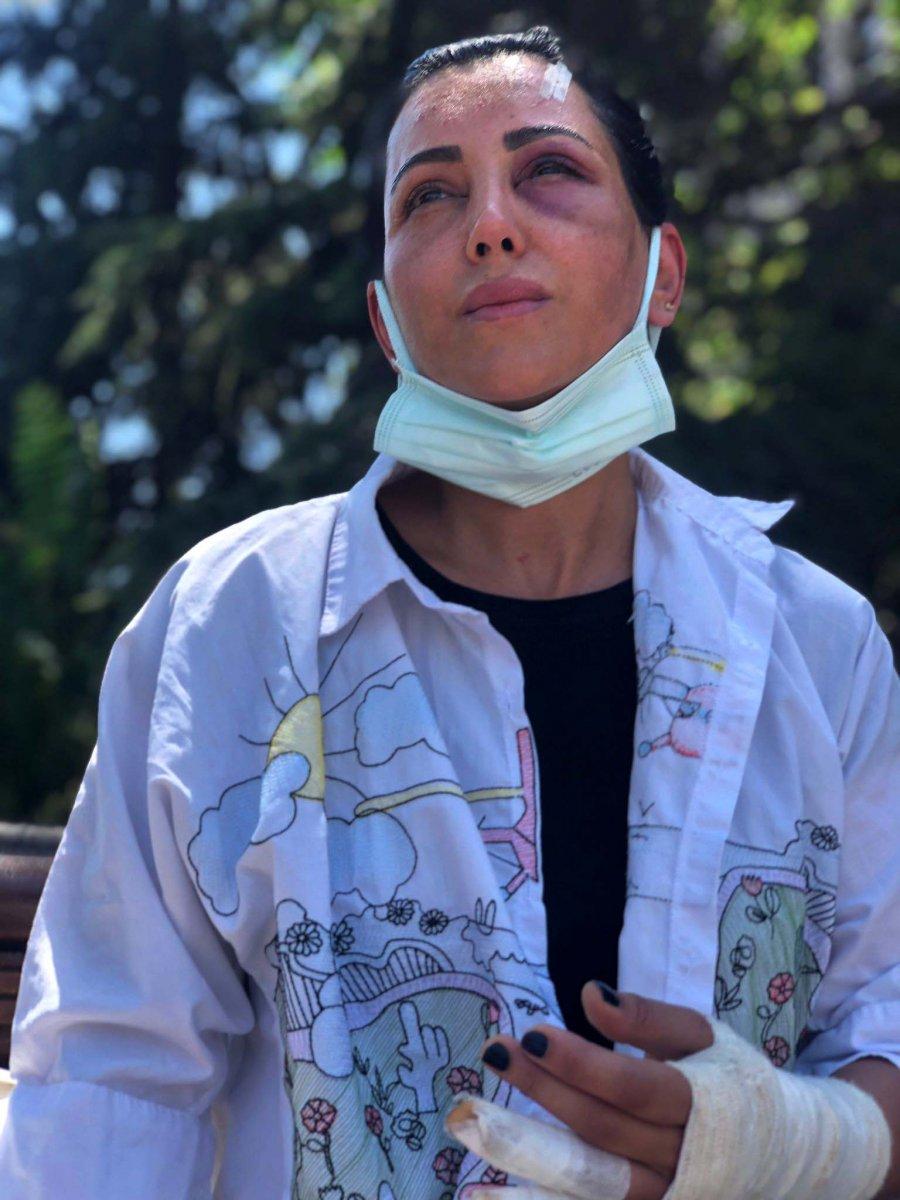 Ankara'da eski sevgilisi tarafından darbedildi