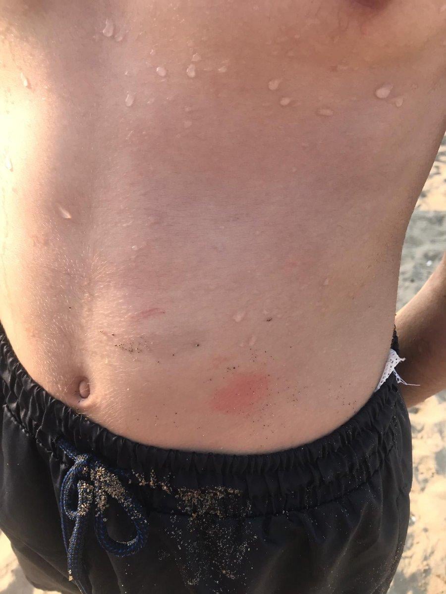 Sakarya'daki kaşıntıların nedeni, deniz anası çıktı