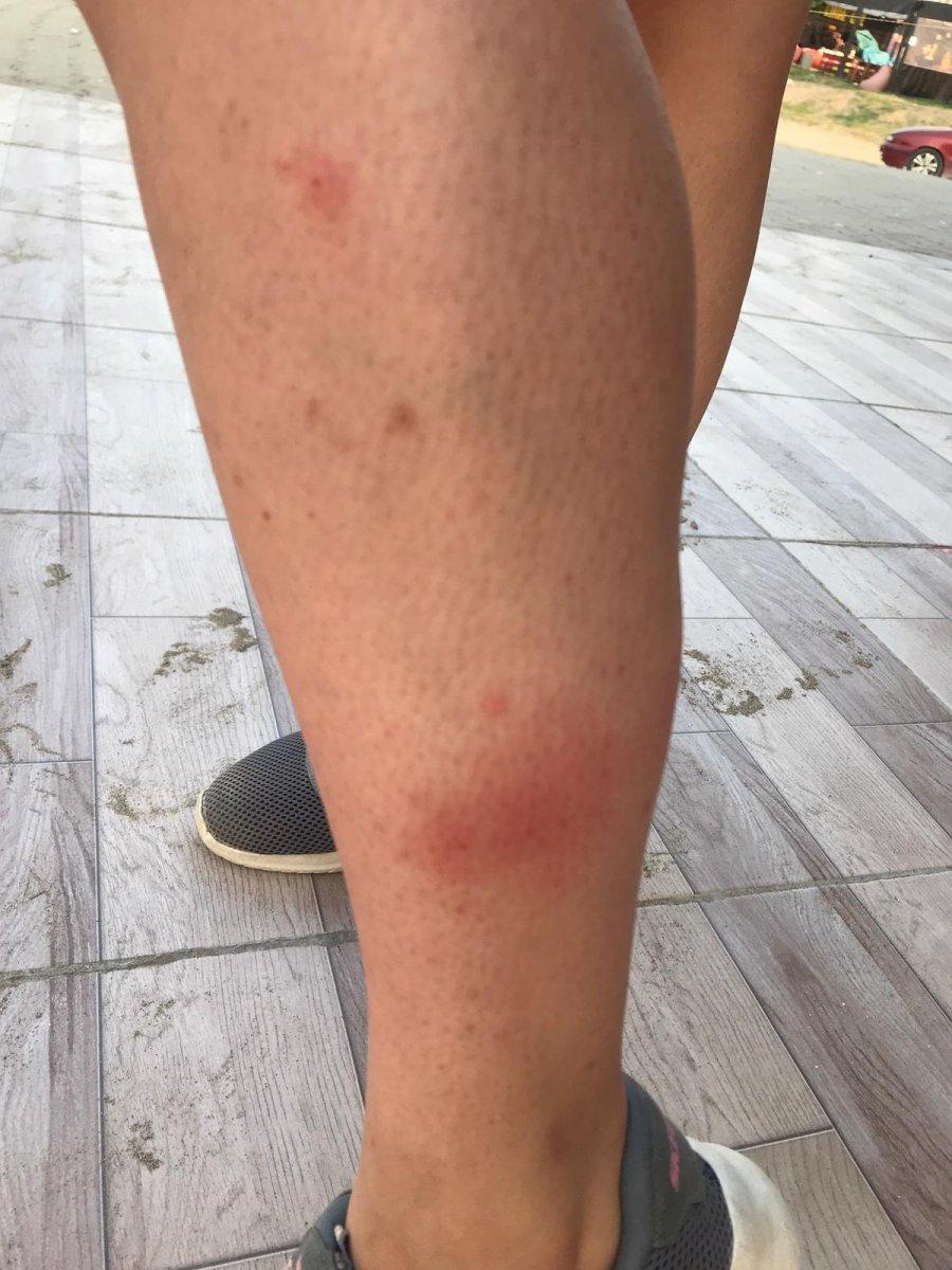 Sakarya'da denize giren 32 kişinin vücudunda kızarıklıklar oluştu