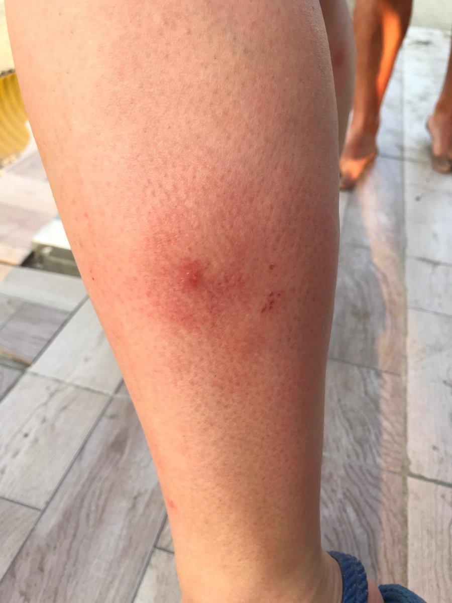 Sakarya'da denize giren 32 kişinin vücudunda kızarıklıklar oluştu