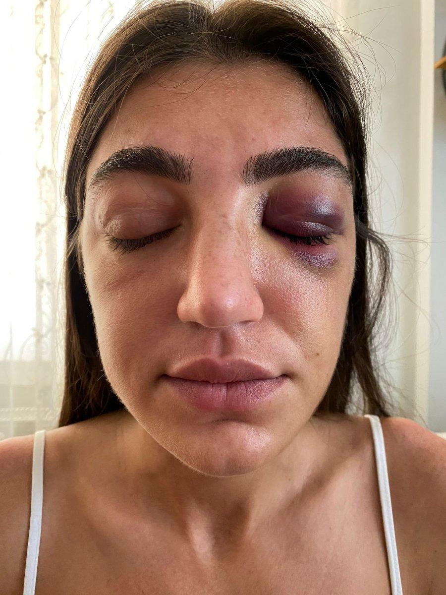 Manken Gizem Akbaş, eski sevgilisi tarafından darbedildi