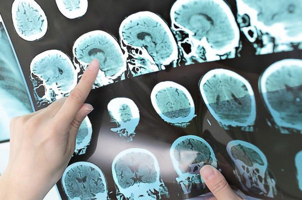 Sessiz ilerleyen 10 ölümcül hastalık