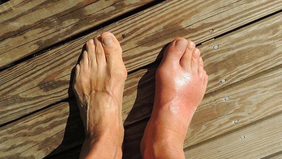 Ürik asidi uzak tutmanıza yardımcı olacak 7 besin