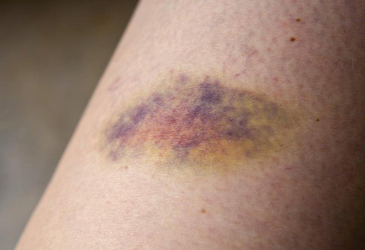 Vücudunuzdaki nedensiz morlukları es geçmeyin