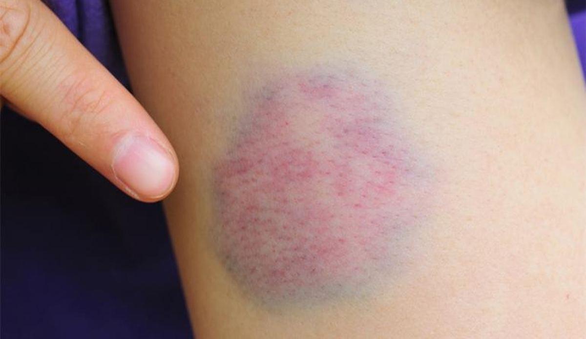 Vücudunuzdaki nedensiz morlukları es geçmeyin