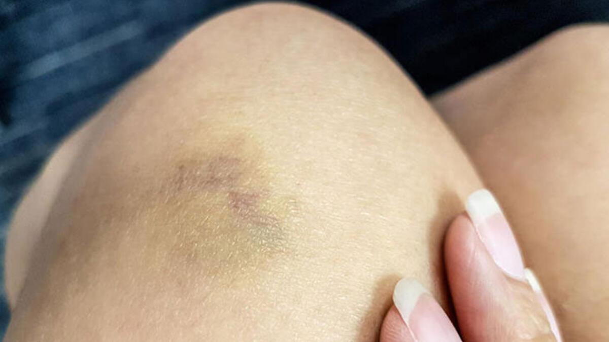 Çabuk yorulma ve aşırı halsizlik lösemi habercisi