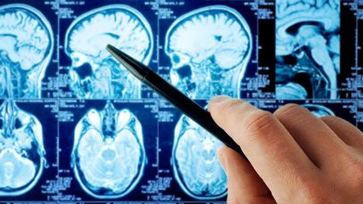 Beyin tümörü belirtileri ve tedavisi