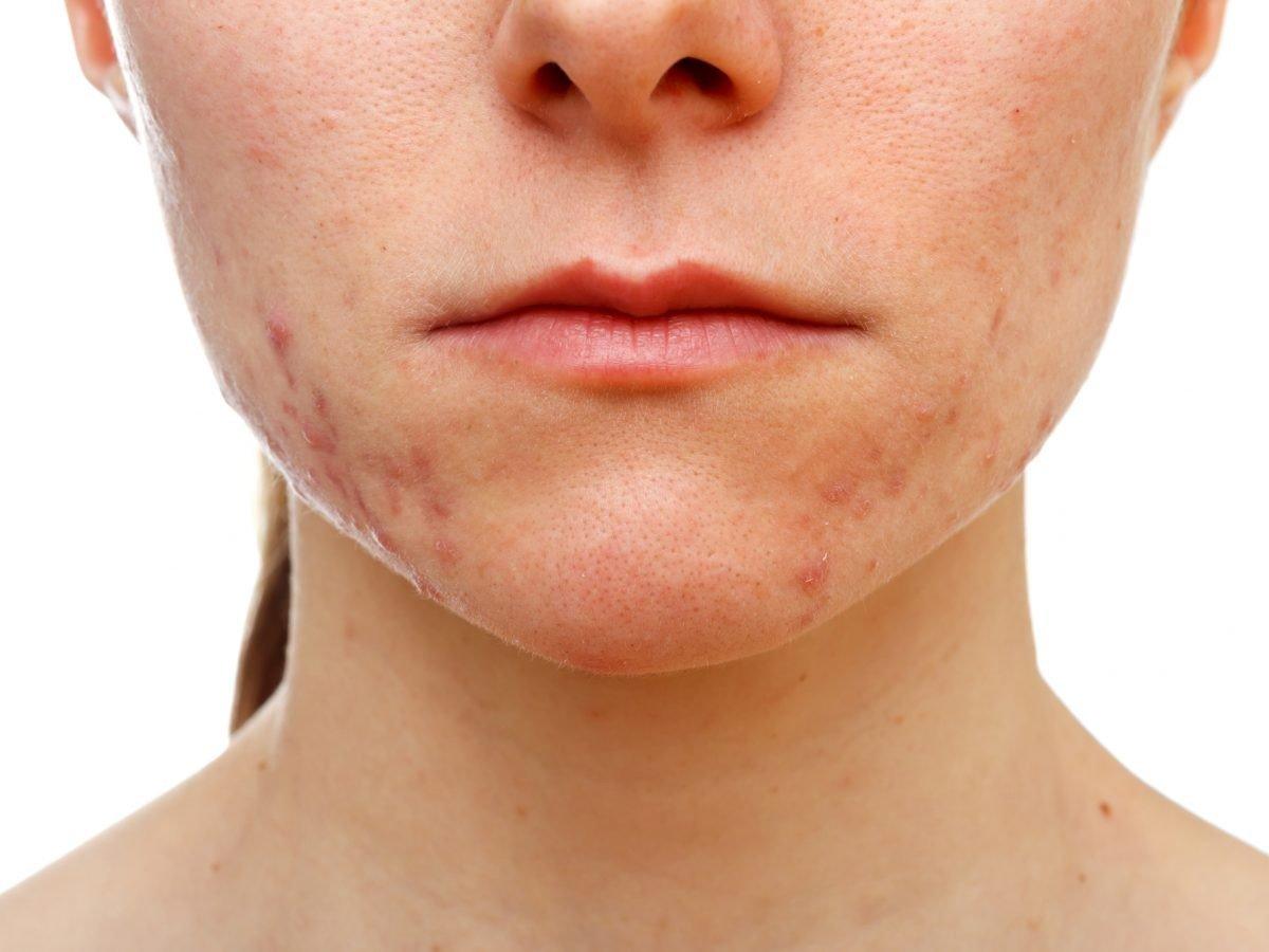 Maske kaynaklı cilt problemlerinden korunmak için öneriler