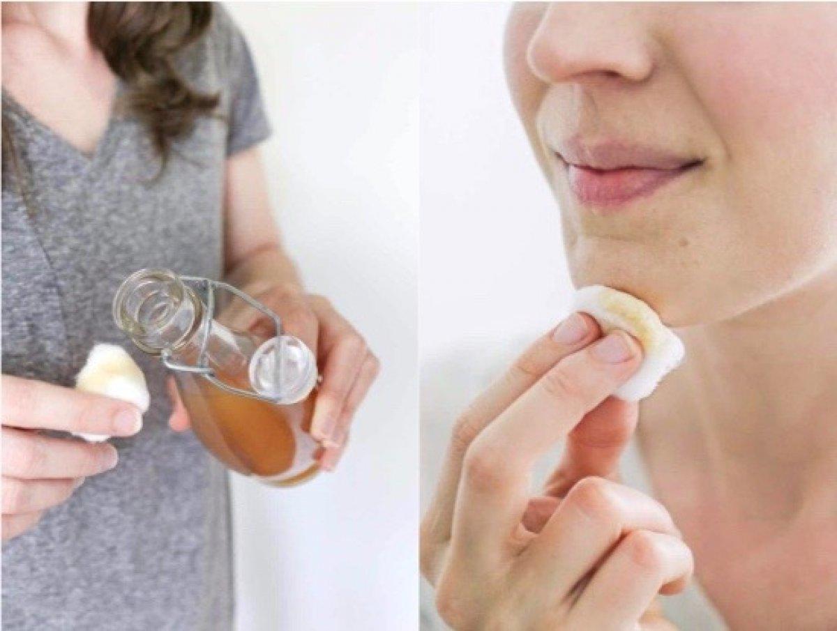 Yüzde oluşan benlerden kurtulmanın doğal yolları